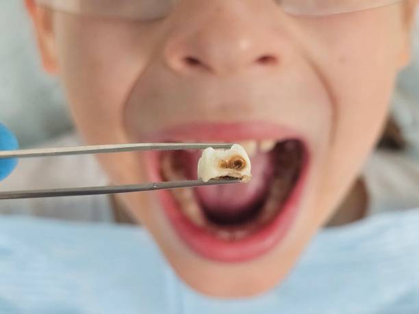 Best Emergency Dentist for Lost Fillings or Crowns in Clinton, SC